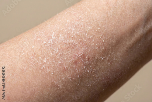 Close-up of dry skin on arm showing texture and irritation with natural background elements