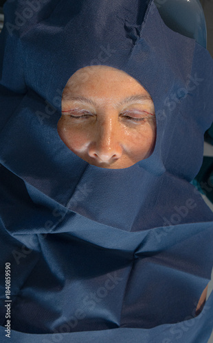 Overhead view of a senior woman's face prepared with sterile drapes and red surgical guide markings on her eyelids, prior to a cosmetic blepharoplasty procedure or eyelid lift surgery.