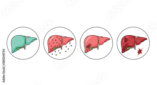 Medical illustration showing the four stages of liver disease progression from a healthy organ to fatty liver, fibrosis, and cirrhosis.