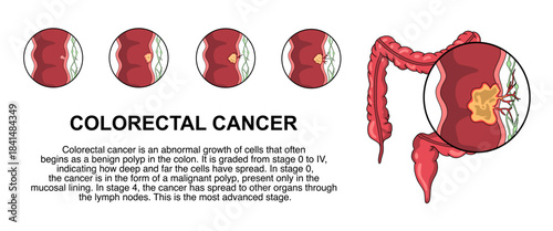 Illustration of colorectal cancer stages. Concept of colon cancer progression. Spread of tumor to lymph nodes. Medical vector illustration for clinics, infographics, education, and science