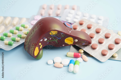 Liver model with pill drug treatment, Cirrhosis, Liver cancer, fatty liver.