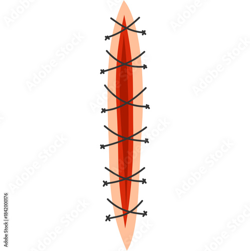 Suture Illustration