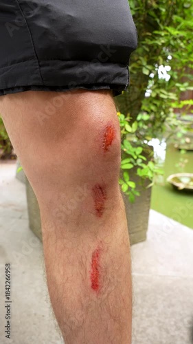 Wallpaper Mural Injured man shows fresh scraped knee and leg after a fall, Vertical Close up Torontodigital.ca
