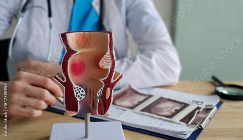 Foto Anatomical model of rectum with hemorrhoids in clinic