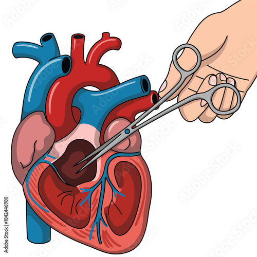 Surgical intervention on a human heart with forceps medical illustration