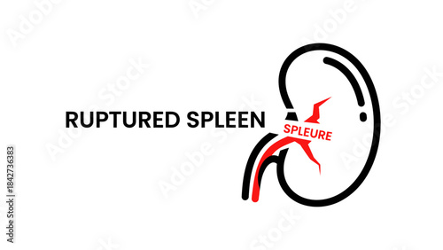 Ruptured Spleen Medical Icon with Hemorrhage. Emergency Trauma Concept. Indonesian: Ruptured Spleen Medical Icon with Hemorrhage. Emergency Trauma Concept.
