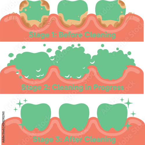 Dental cleaning stages illustration showing plaque removal process, before and after teeth hygiene diagram, oral care infographic for dentistry education design