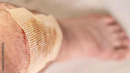 Fotografie A man with a severe shin injury