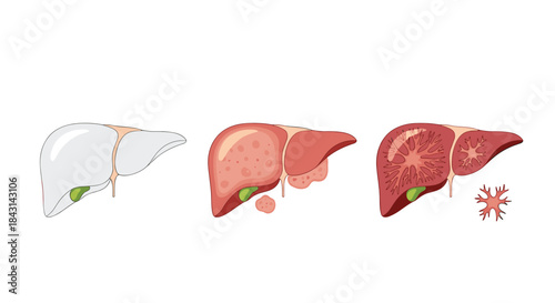 Medical illustration showing the progression of liver disease, from a fatty liver to cirrhosis and finally liver cancer or failure.