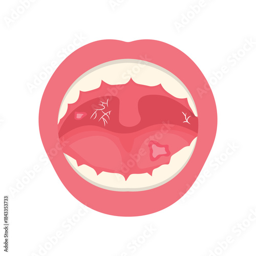Mouth Infection Illustration