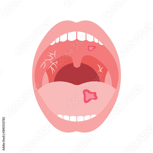 Mouth Infection Illustration