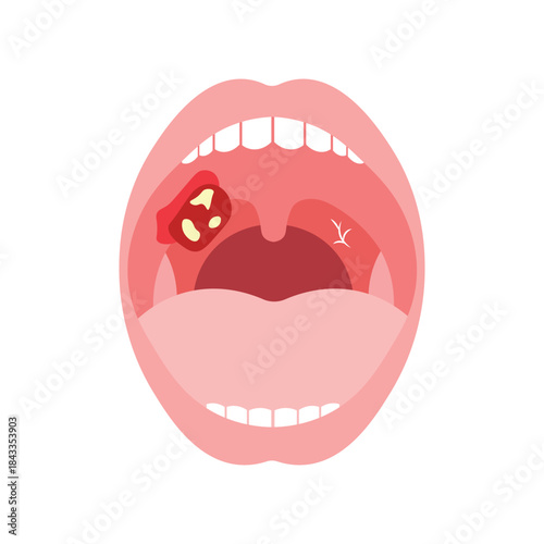 Mouth Infection Illustration
