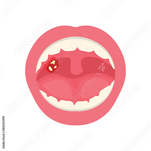 Mouth Infection Illustration