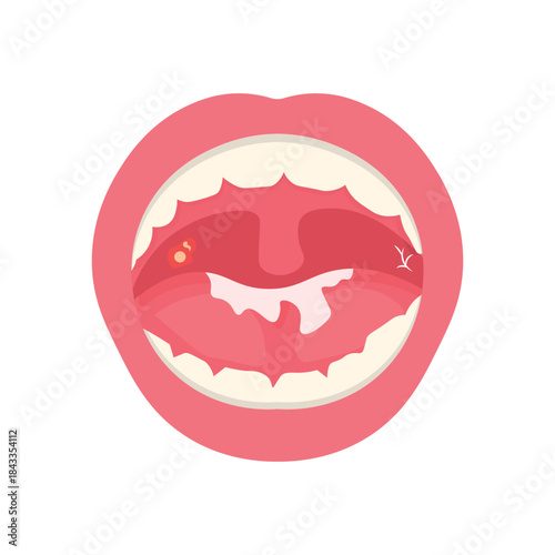 Mouth Infection Illustration