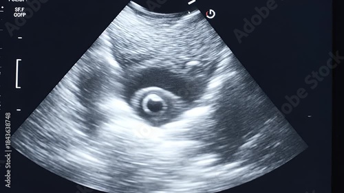 Medical Ultrasound Scan Displaying Fetal Development in Early Pregnancy.