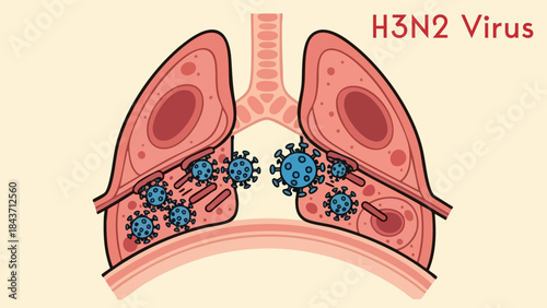 H3n2 influenza virus infection illustration showing microscopic pathogens attacking human respiratory system lungs