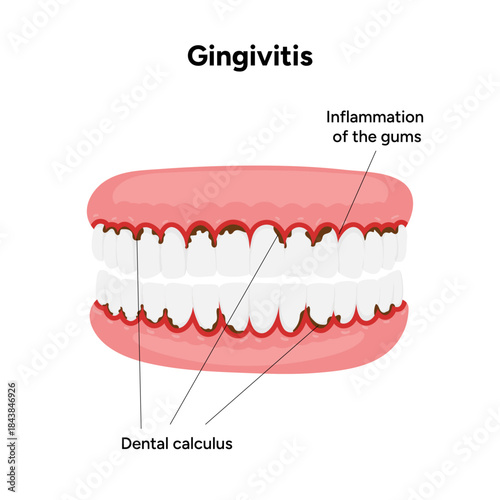 Hand-drawn dental illustration teeth affected by gingivitis. Educational medical infographic gum inflammation, redness, and early stages of periodontal disease