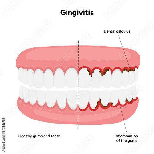 Hand-drawn dental illustration teeth affected by gingivitis. Educational medical infographic gum inflammation, redness, and early stages of periodontal disease