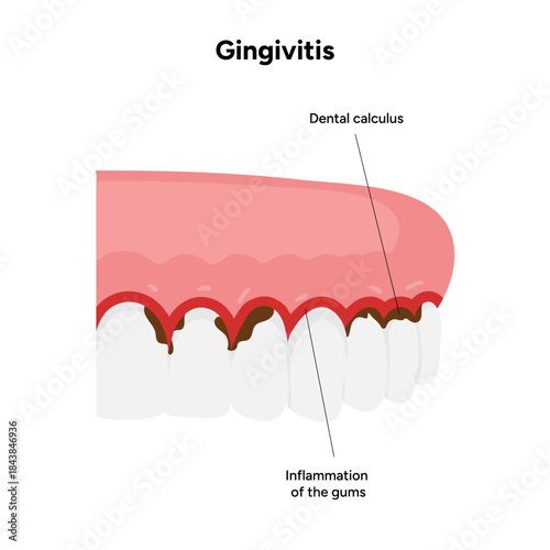 Hand-drawn dental illustration teeth affected by gingivitis. Educational medical infographic gum inflammation, redness, and early stages of periodontal disease