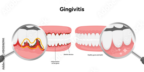 Hand-drawn dental illustration teeth affected by gingivitis. Educational medical infographic gum inflammation, redness, and early stages of periodontal disease