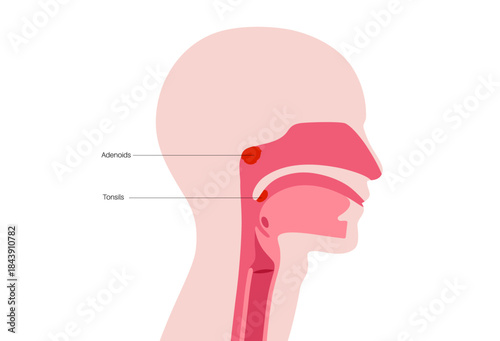 Adenotonsillar disease poster