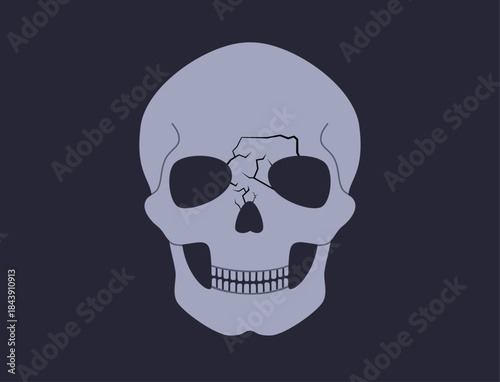 Nasal fracture poster