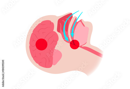 Obstructive sleep apnea
