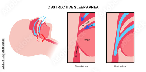 Obstructive sleep apnea