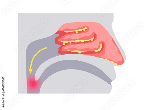 Postnasal drip poster
