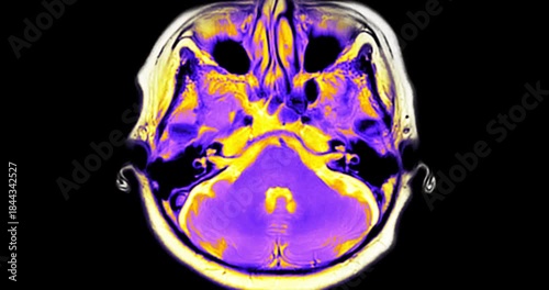 MRI brain footage showing normal anatomy with no abnormal findings. Clear visualization of brain structures highlights healthy neurological status. Ideal for medical education.