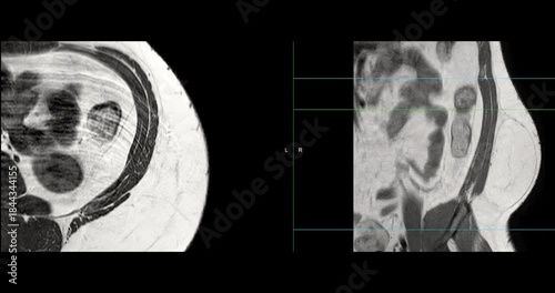 MRI whole abdomen video showing a fatty mass on the left side of the abdomen. Findings suggest a probable atypical lipomatous tumor, with differential diagnosis of well-differentiated liposarcoma. 