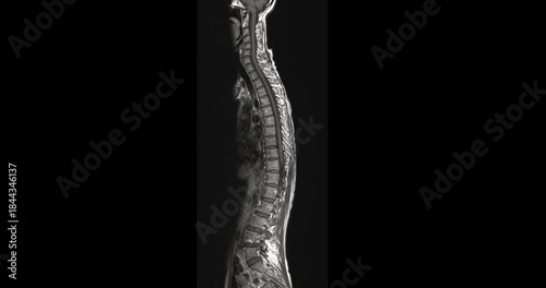 MRI screening of the whole spine in sagittal view for evaluating spinal cord stenosis. Clear visualization of vertebrae, discs, and spinal canal supports accurate diagnosis. 
