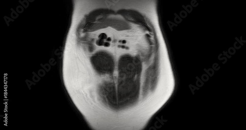 MRI whole abdomen video showing a fatty mass on the left side of the abdomen. Findings suggest a probable atypical lipomatous tumor, with differential diagnosis of well-differentiated liposarcoma. 