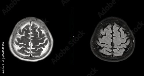 MRI brain footage showing normal anatomy with no abnormal findings. Clear visualization of brain structures highlights healthy neurological status. Ideal for medical education.