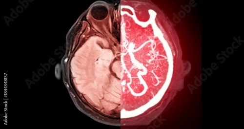 Fusion imaging combining MRI brain and CTA brain in axial view. This advanced technique enhances visualization of brain tissue and cerebral vessels. 