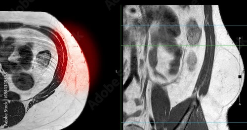 MRI whole abdomen video showing a fatty mass on the left side of the abdomen. Findings suggest a probable atypical lipomatous tumor, with differential diagnosis of well-differentiated liposarcoma. 