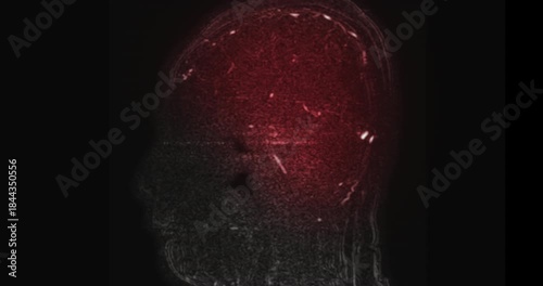 MR cerebral venography (MRV) or MRV Brain for diagnostic Cerebral venous thrombosis (blood clots in the brain) and 
Structural vein abnormalities.