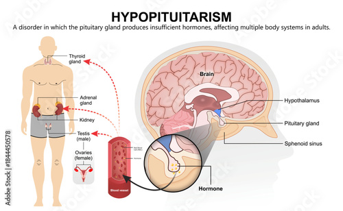 Hypopituitarism in Adult Medical Infographic Flashcard