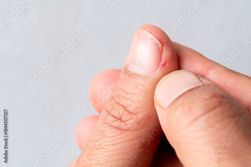 Human fingernail with redness and minor wound around the cuticle, showing nail infection, hangnail irritation, or paronychia. Medical health concept, skin problem detail. macrophoto