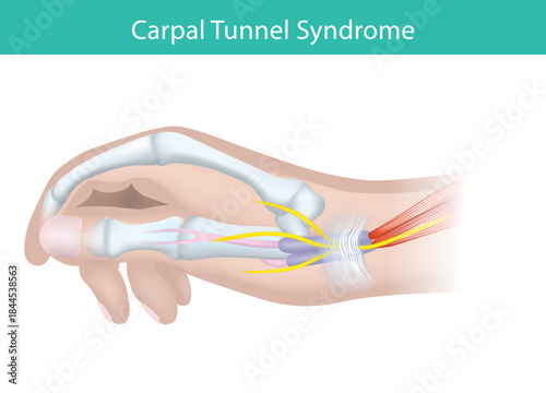 Carpal Tunnel Syndrome Nerve Compression