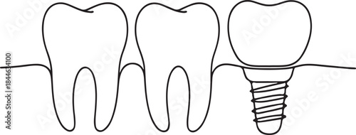 Dental implant and natural teeth line art on gray background