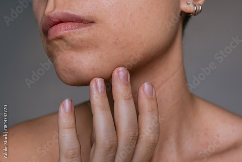 Close up of female chin with small pimples and uneven skin texture. Natural skin condition, skincare and dermatology concept, sensitive skin, beauty realism, cosmetic care and skin health