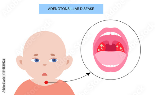 Adenotonsillar disease poster