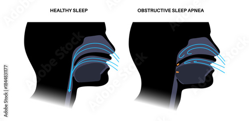 Obstructive sleep apnea