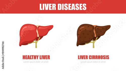 Liver disease. Healthy and cirrhosis liver. Internal organ icons. Medical illustration. Vector design.