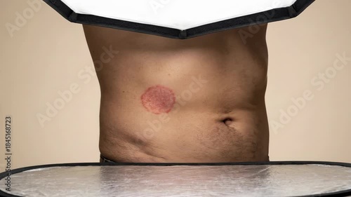 Close-up of a persons torso showing a red circular rash on the skin.