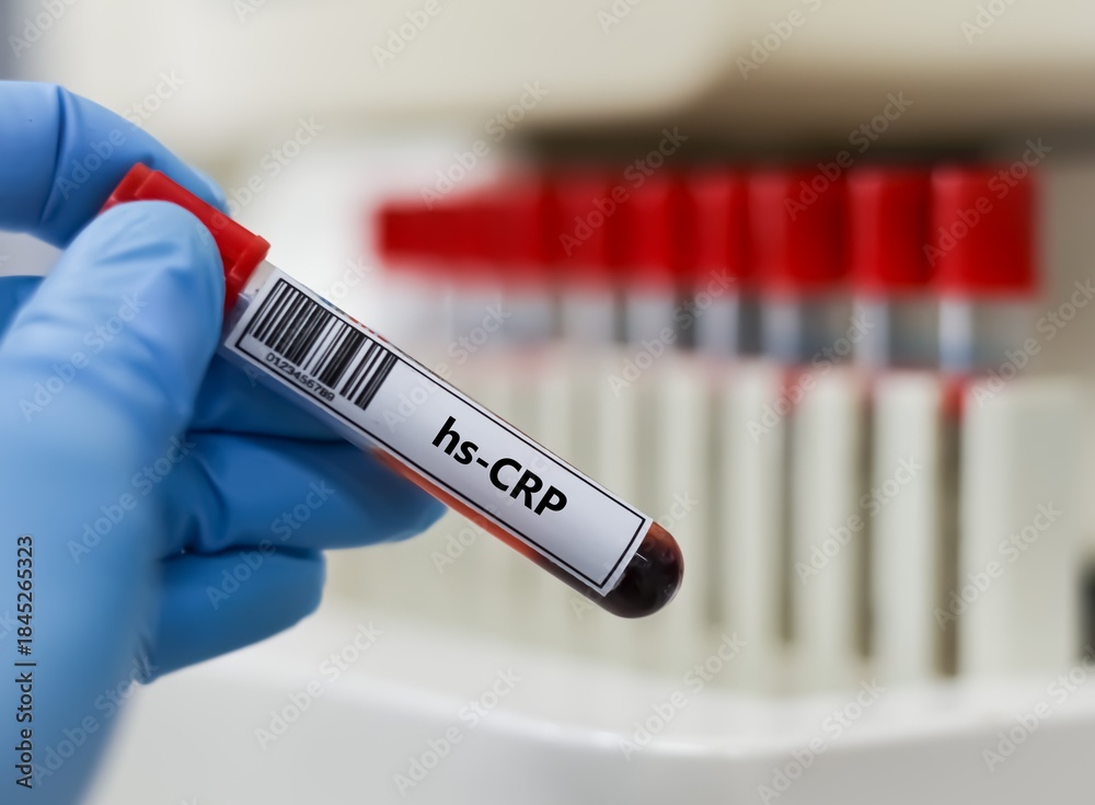 Fototapeta premium Blood sample tube for hs-CRP test analysis.