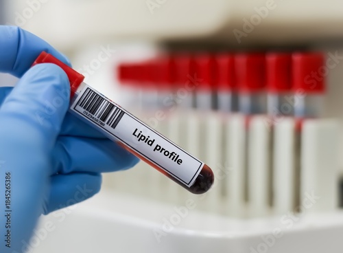 Photos Blood sample tube for lipid profile test analysis.