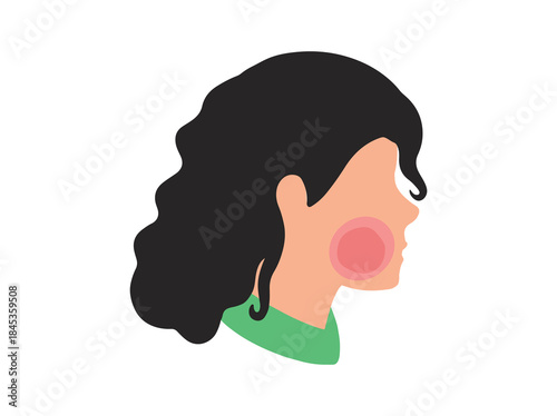 Erythema Infectiosum in Skin Illustration
