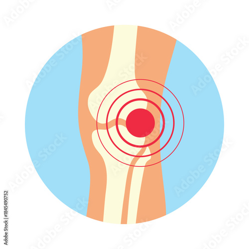 Illustration of arthritis or arthrosis of the knee joint using visual representation of pain signals and joint structure.